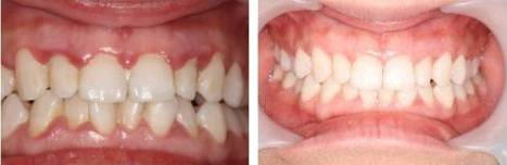 歯周病の症例　1
