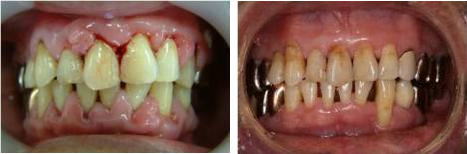 歯周病の症例　2