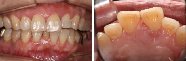 歯周病の症例　3　歯周病の外科治療