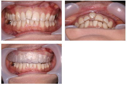 とりはずしタイプの矯正