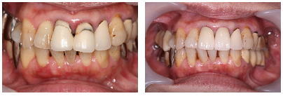 差し歯をオールセラミックに