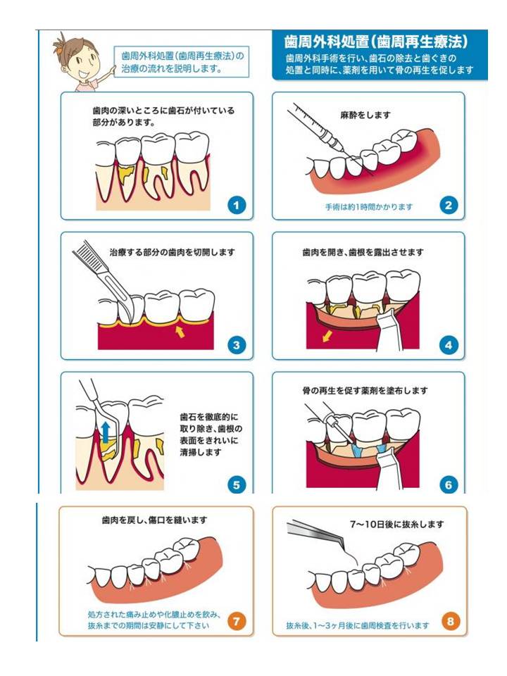 歯周組織再生療法 | 歯科｜大阪府堺市の藤井歯科