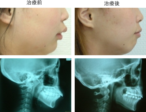 矯正治療症例３