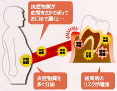 お腹ぽっこり 歯周病.png