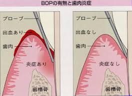 Bbopの意味.jpg