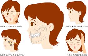 G顎関節症の症状.jpg