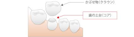 H歯のかぶせ.jpg