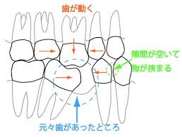 H歯の放置.jpg