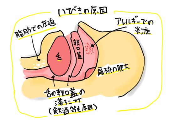 Iいびきの原因.png
