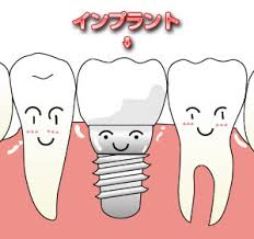 Iインプラント歴史.jpg