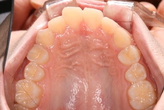 虫歯なし 虫歯なし