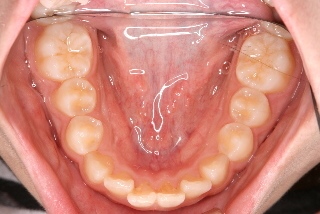 虫歯なし 虫歯なし