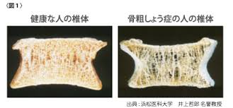 K骨そしょう症の椎体.jpg