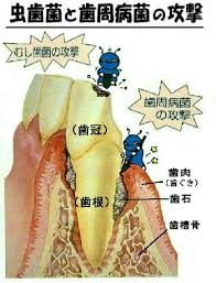 M虫歯菌と歯周病菌の攻撃.jpg