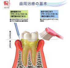 S歯周基本治療.jpg