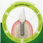 ストローマンインプラント