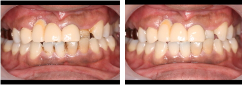 歯をきれいにするエアーフロー 歯をきれいにするエアーフロー