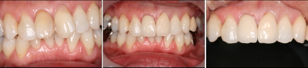 オールセラミックで治す