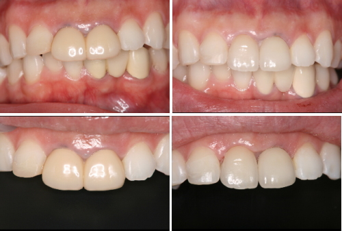 オールセラミック症例