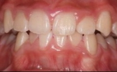 矯正治療症例２ 治療後