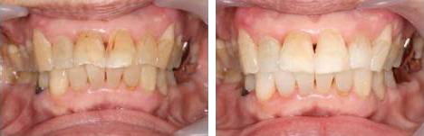 ホワイトニング症例　１